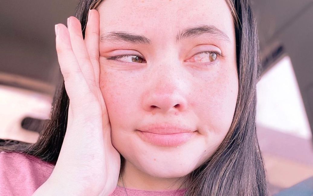 Девушка живет с уникальной аллергией: старается не потеть, не может плакать и принимать душ