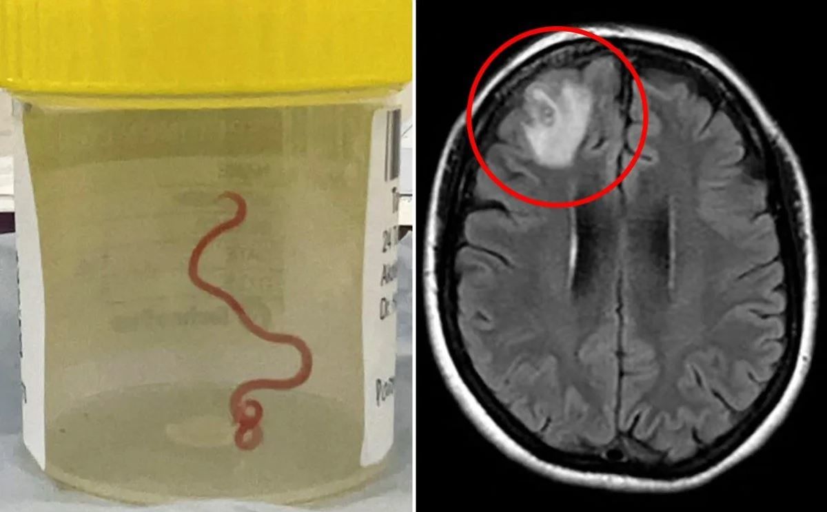 Із мозку жінки видалили живого 8-сантиметрового черв'яка: заразилася від пітона